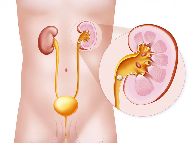 Sỏi niệu quản trái đoạn đầu là gì?