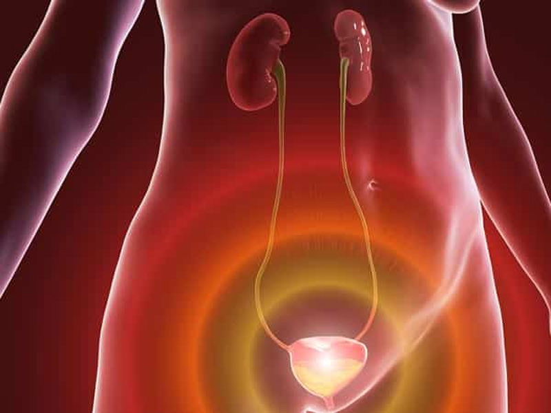 Sỏi niệu đạo là gì?