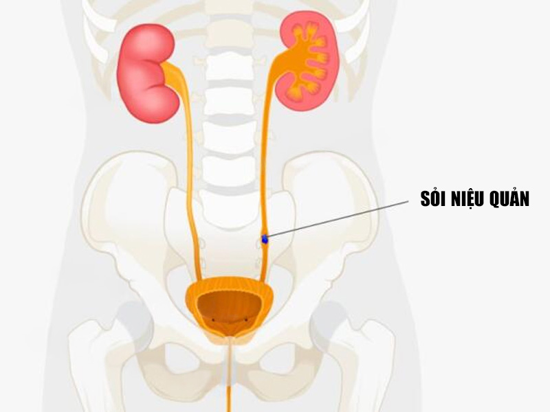 Sỏi niệu quản trái đoạn ⅓ dưới