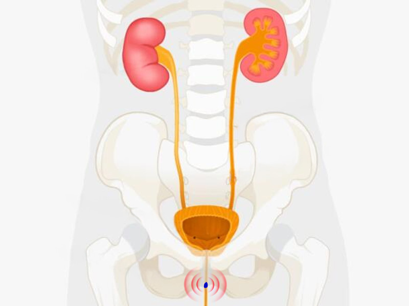  Sỏi thận có kích thước dưới 7mm, trơn nhẵn thì khả năng tự đào thải ra ngoài cao